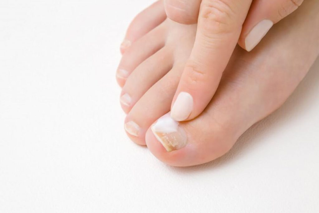 Tırnak Mantarı Nasıl Geçer?